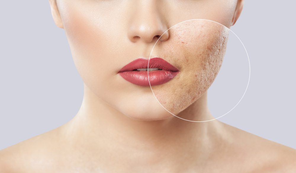 acne-vrouw
