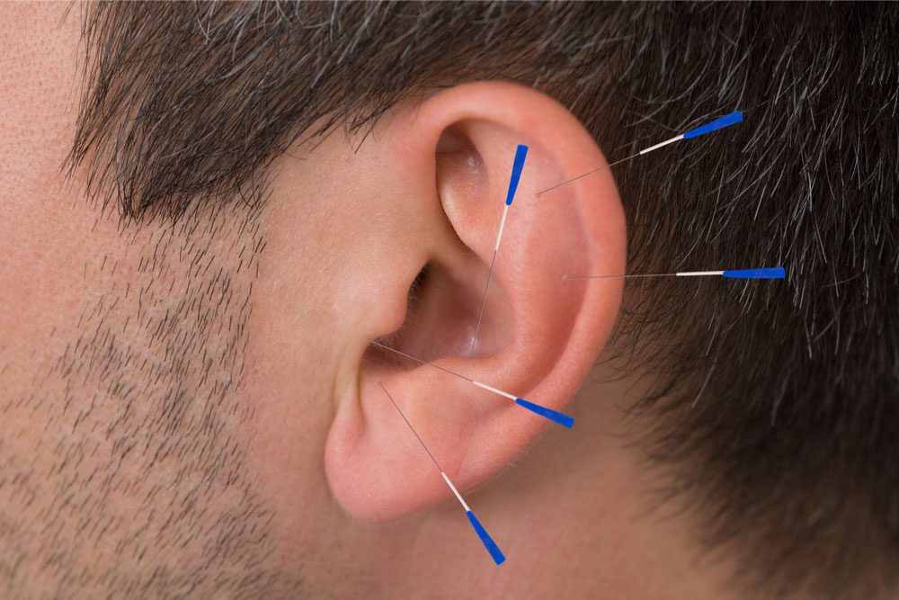acupunctuur
