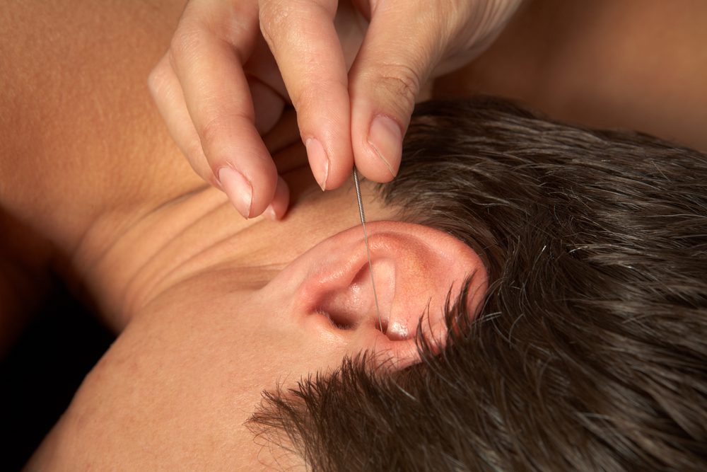 acupunctuur-2