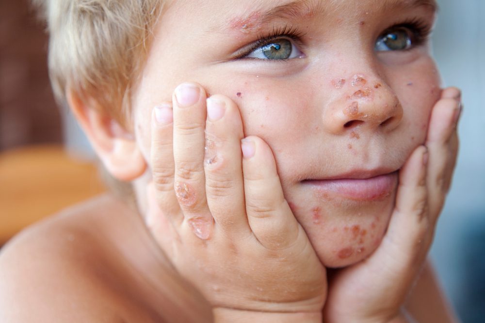 Psoriasis in het gezicht