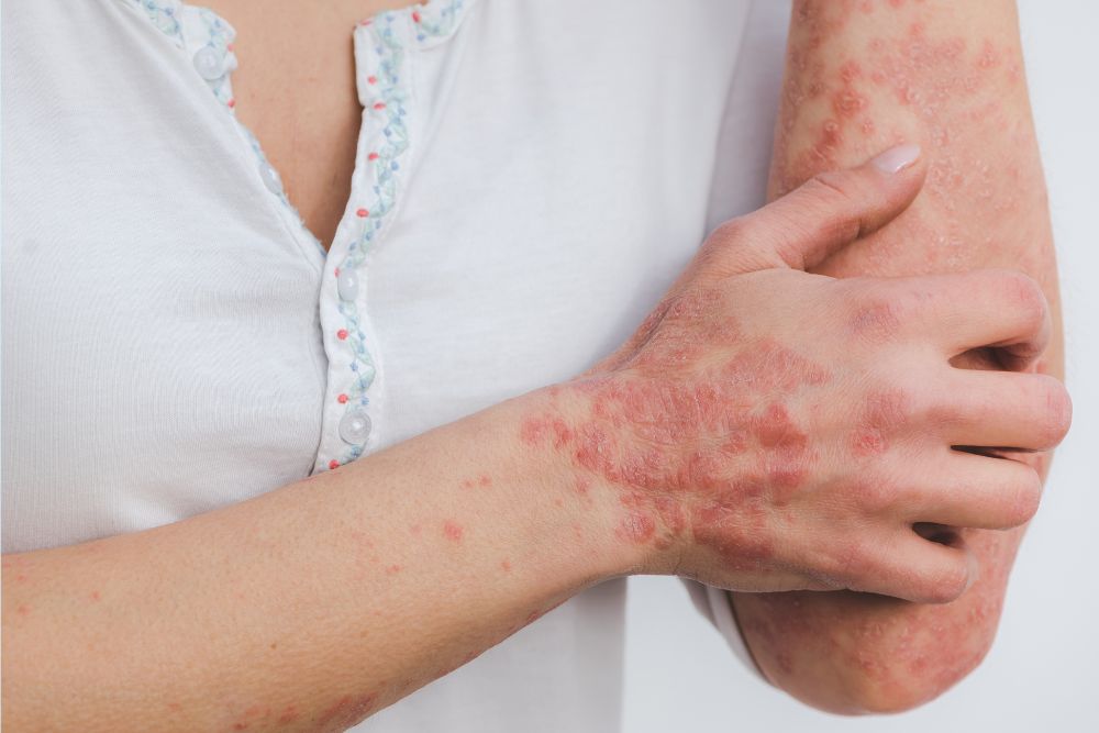Ontstekingen centraal bij psoriasis